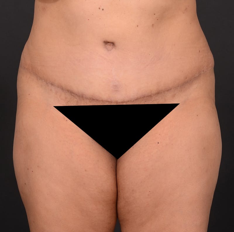 Tummy Tuck Before & After Gallery - Patient 140134450 - Image 2