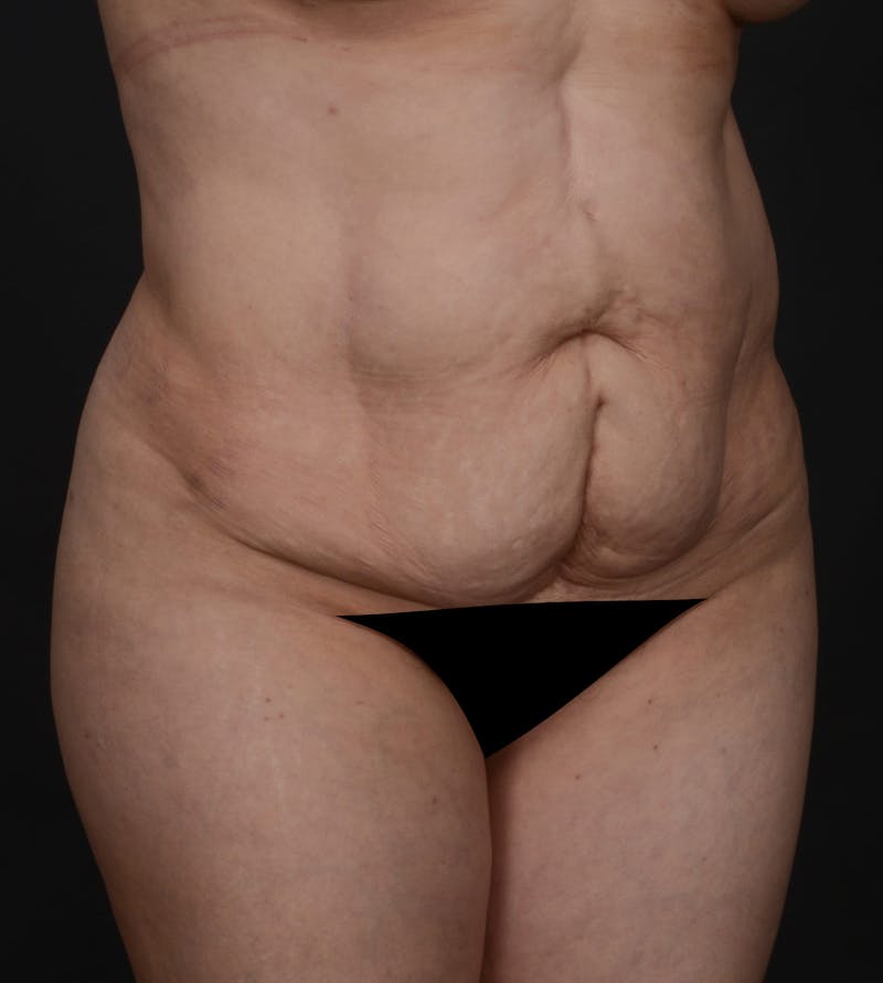 Tummy Tuck Before & After Gallery - Patient 140118169 - Image 1