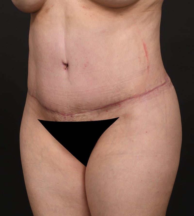 Tummy Tuck Before & After Gallery - Patient 140118169 - Image 4