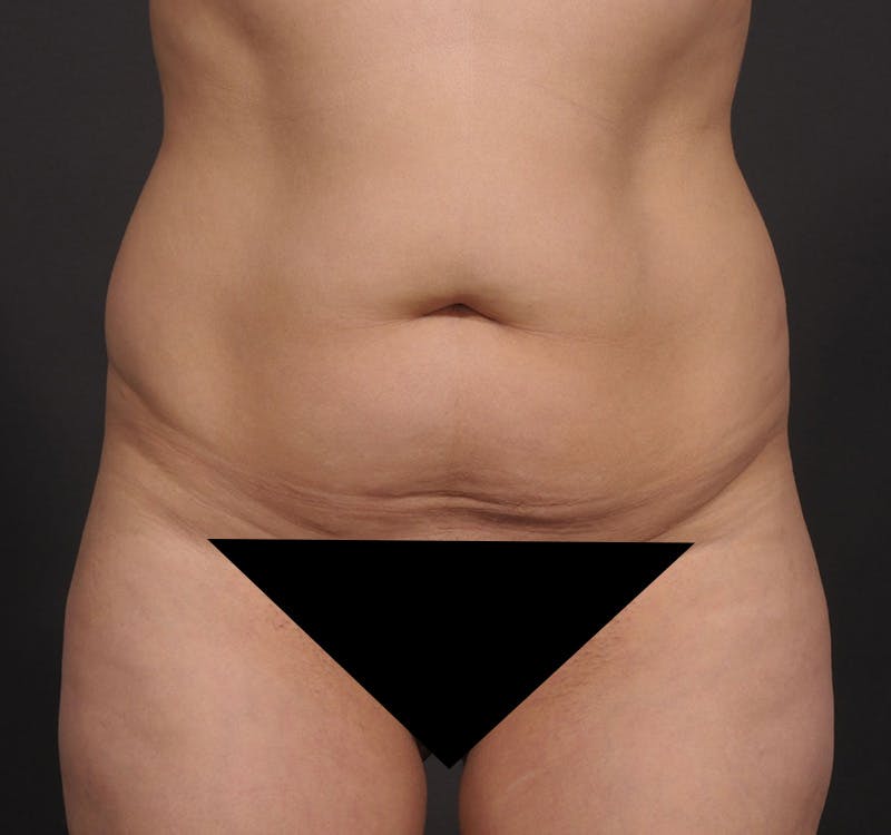 Tummy Tuck Before & After Gallery - Patient 154995798 - Image 1