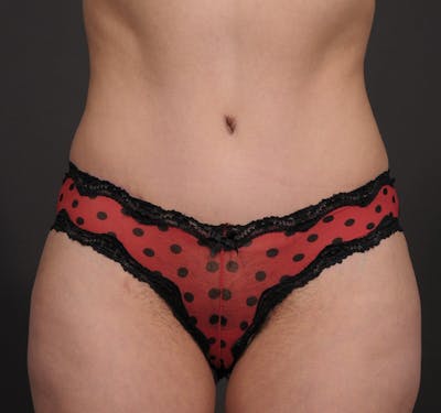 Liposuction Before & After Gallery - Patient 154995799 - Image 2