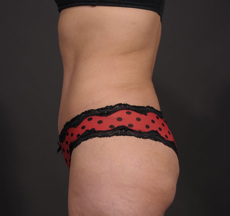 Tummy Tuck Before & After Gallery - Patient 154995798 - Image 12