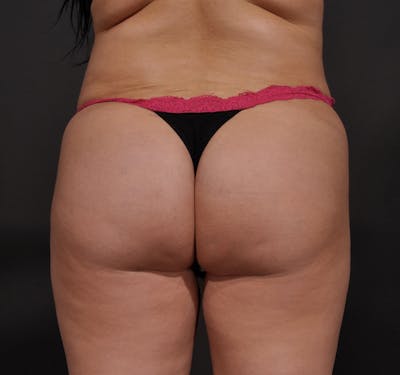 Brazilian Butt Lift Before & After Gallery - Patient 155405544 - Image 2