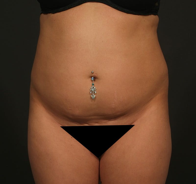 Liposuction Before & After Gallery - Patient 155405547 - Image 1
