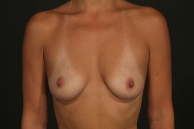 Breast Augmentation Before & After Gallery - Patient 155405747 - Image 1