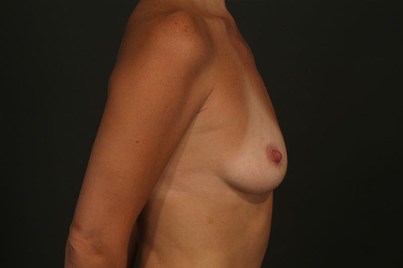 Breast Augmentation Before & After Gallery - Patient 155405747 - Image 5