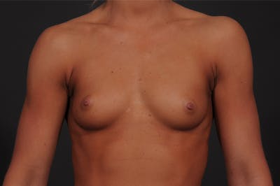 Breast Augmentation Before & After Gallery - Patient 155407757 - Image 1