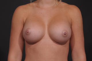 Breast Augmentation Before & After Gallery - Patient 155407757 - Image 2