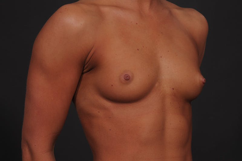 Breast Augmentation Before & After Gallery - Patient 155407757 - Image 3