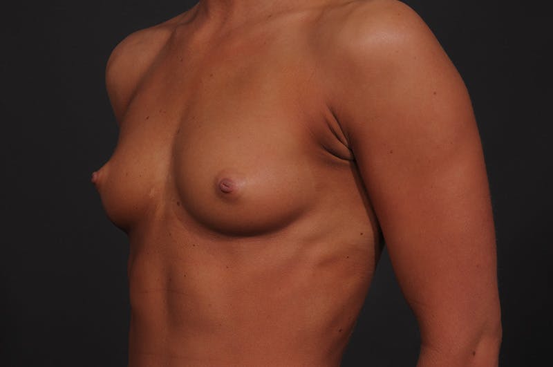 Breast Augmentation Before & After Gallery - Patient 155407757 - Image 7