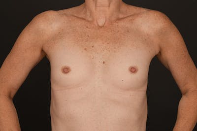 Breast Augmentation Before & After Gallery - Patient 155407756 - Image 1