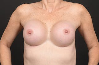 Breast Augmentation Before & After Gallery - Patient 155407756 - Image 2