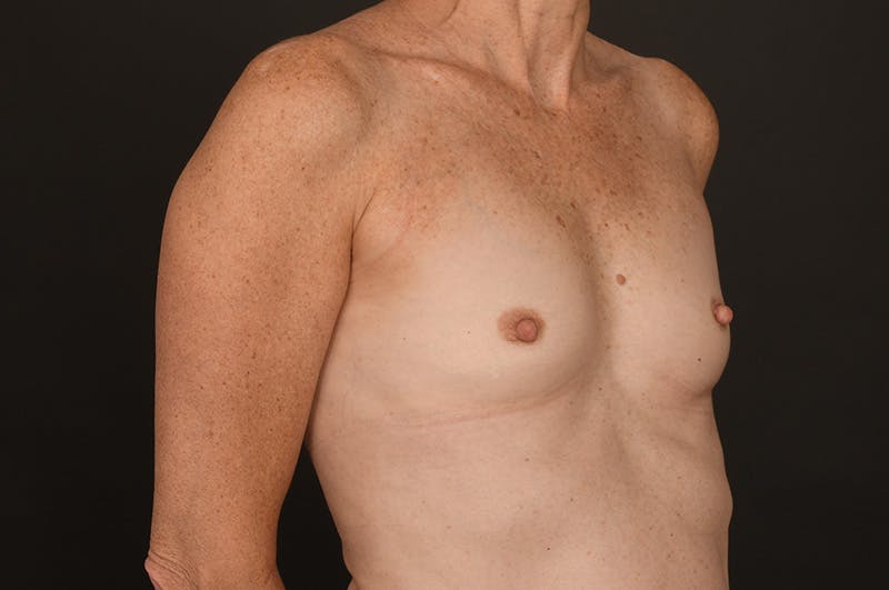 Breast Augmentation Before & After Gallery - Patient 155407756 - Image 3