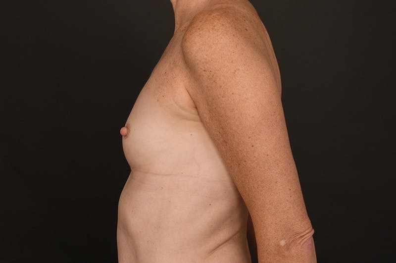 Breast Augmentation Before & After Gallery - Patient 155407756 - Image 9