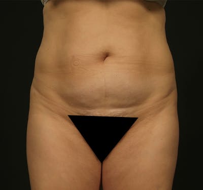 Liposuction Before & After Gallery - Patient 155407797 - Image 1