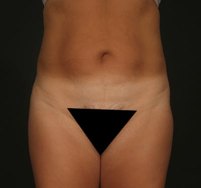 Liposuction Before & After Gallery - Patient 155407797 - Image 2