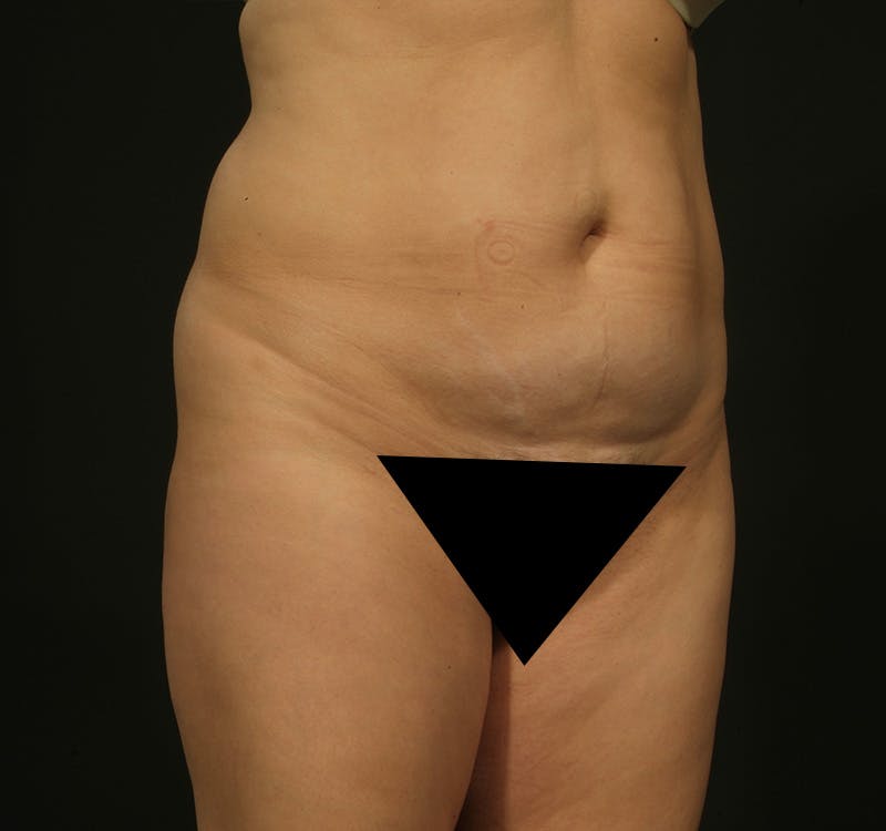 Liposuction Before & After Gallery - Patient 155407797 - Image 3