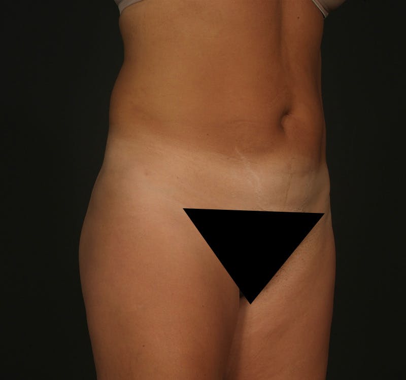 Liposuction Before & After Gallery - Patient 155407797 - Image 4