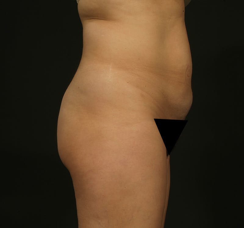 Liposuction Before & After Gallery - Patient 155407797 - Image 5