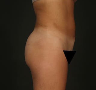 Liposuction Before & After Gallery - Patient 155407797 - Image 6