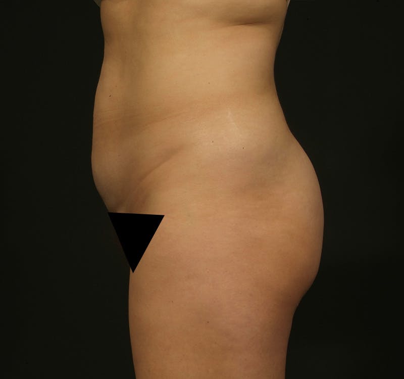 Liposuction Before & After Gallery - Patient 155407797 - Image 9