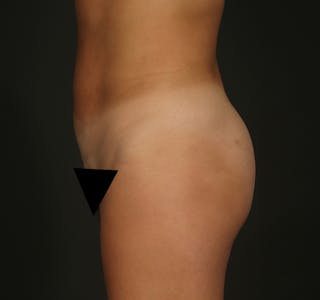 Liposuction Before & After Gallery - Patient 155407797 - Image 10