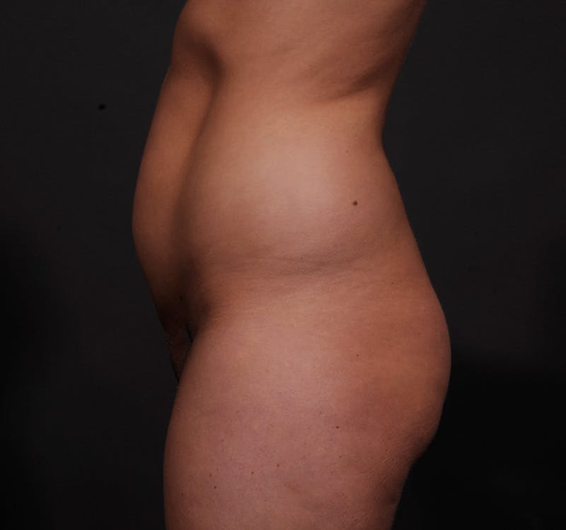 Liposuction Before & After Gallery - Patient 155407853 - Image 13