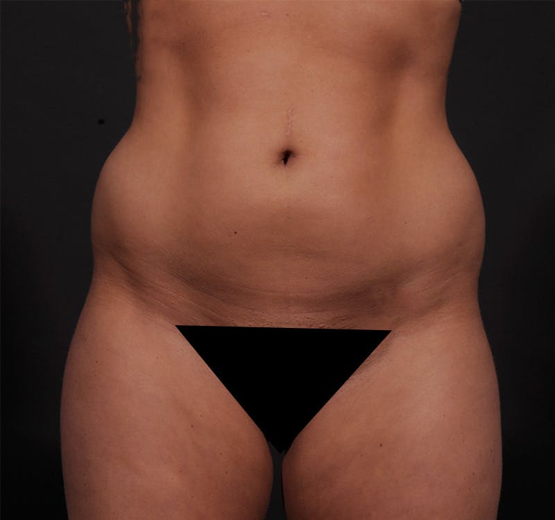 Liposuction Before & After Gallery - Patient 155407853 - Image 1