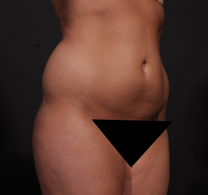 Liposuction Before & After Gallery - Patient 155407853 - Image 3
