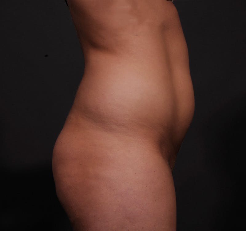 Liposuction Before & After Gallery - Patient 155407853 - Image 5