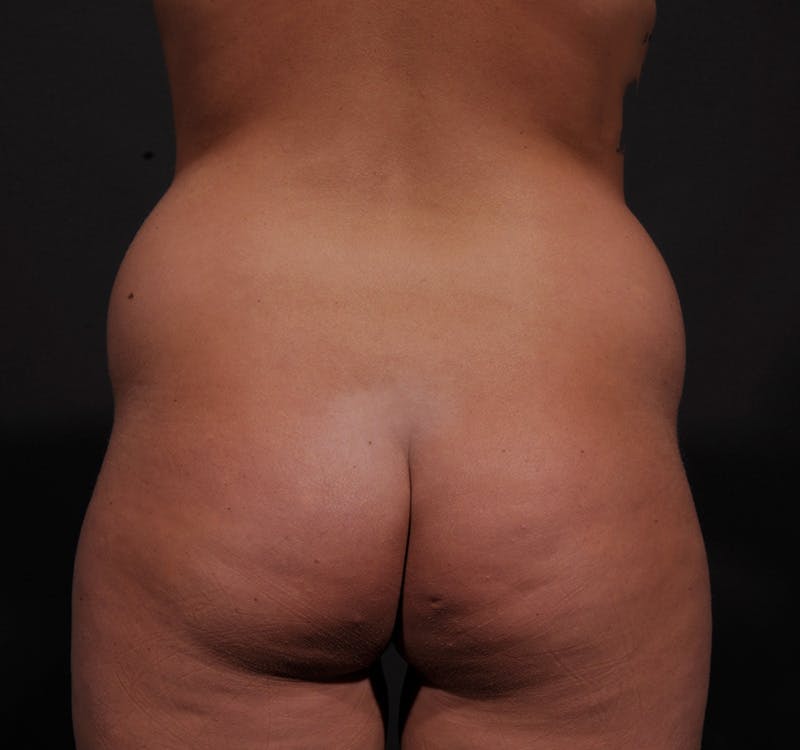 Liposuction Before & After Gallery - Patient 155407853 - Image 7