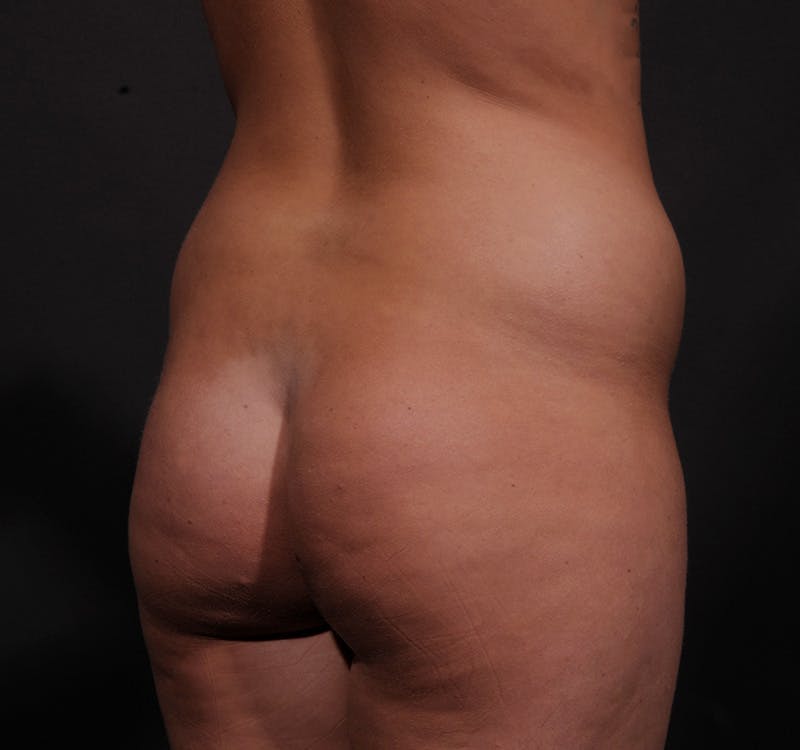 Liposuction Before & After Gallery - Patient 155407853 - Image 9