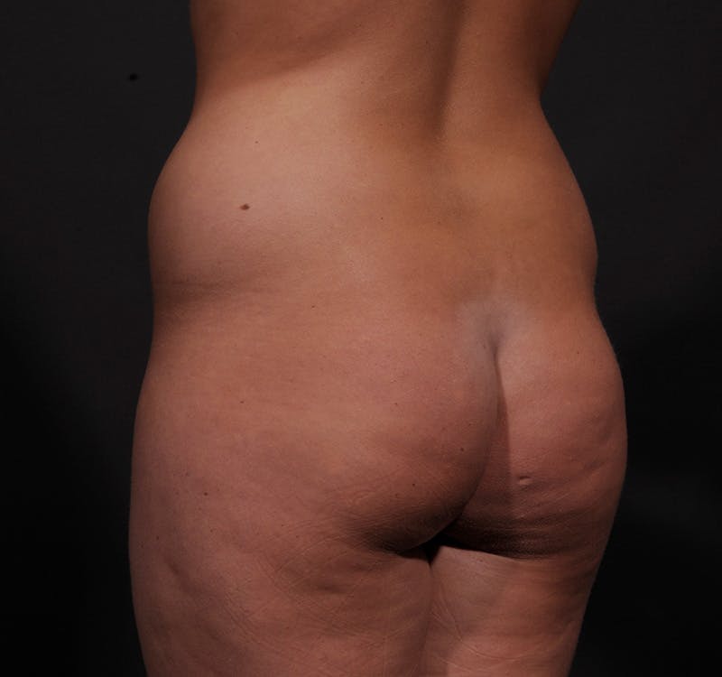 Liposuction Before & After Gallery - Patient 155407853 - Image 11