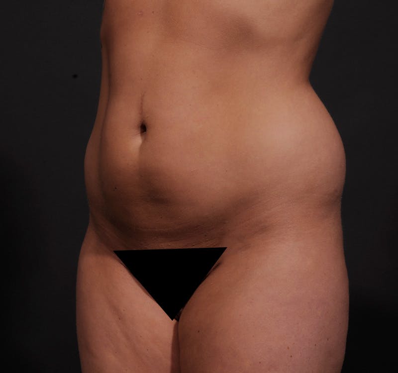 Liposuction Before & After Gallery - Patient 155407853 - Image 15