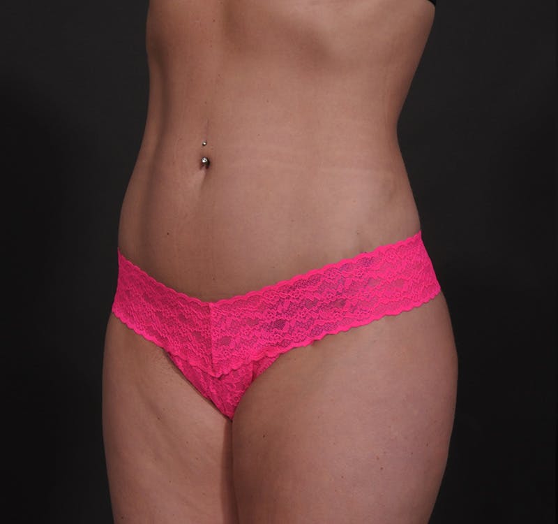 Liposuction Before & After Gallery - Patient 155407853 - Image 16