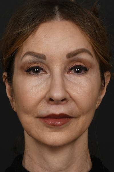 Lip Lift Before & After Gallery - Patient 155407961 - Image 2