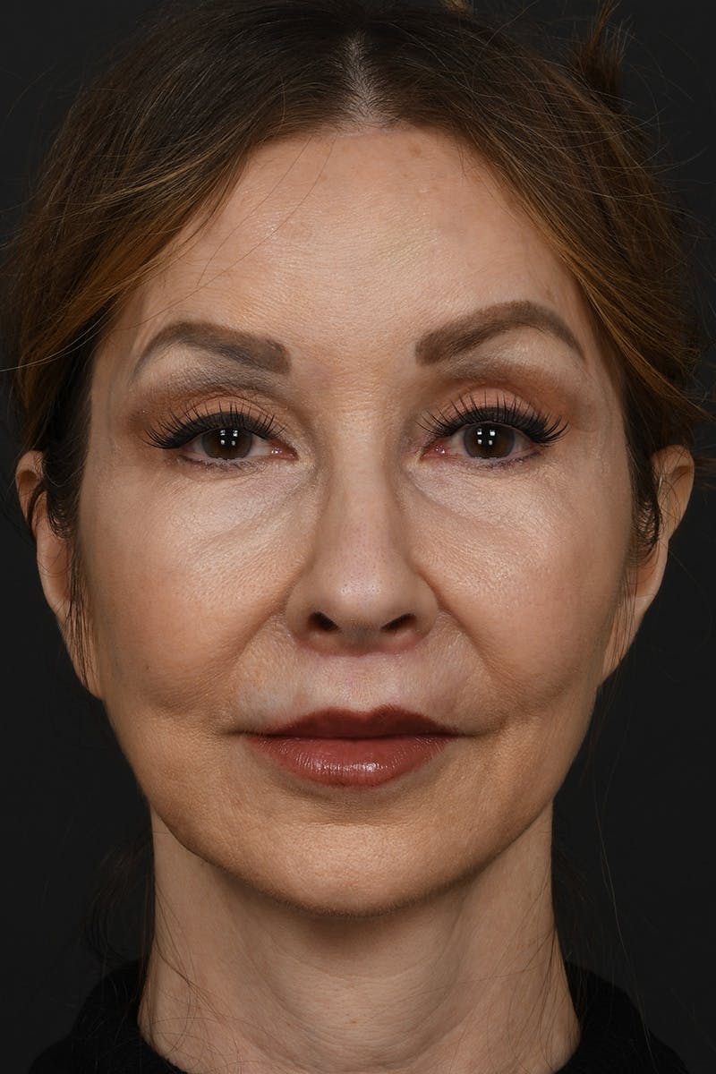 Lip Lift Before & After Gallery - Patient 155407961 - Image 2