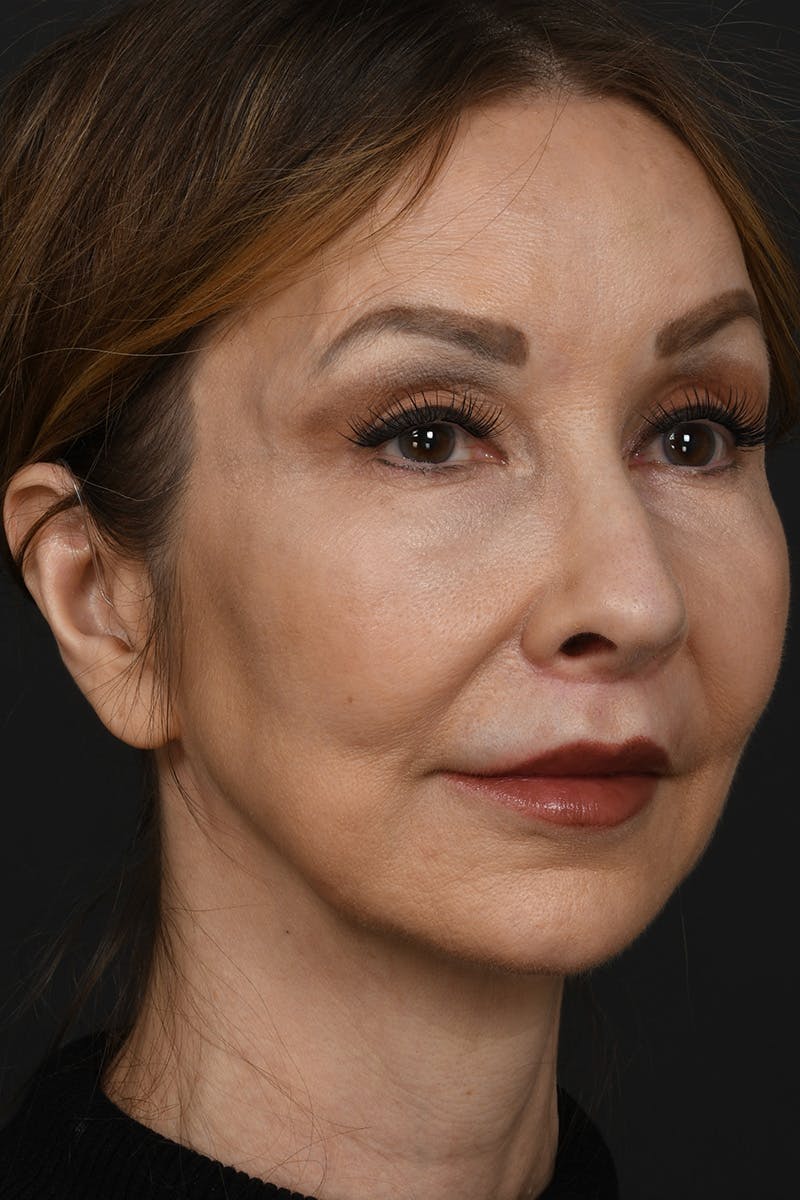 Lip Lift Before & After Gallery - Patient 155407961 - Image 4