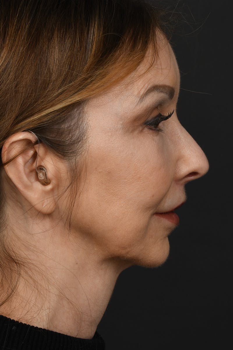 Lip Lift Before & After Gallery - Patient 155407961 - Image 6