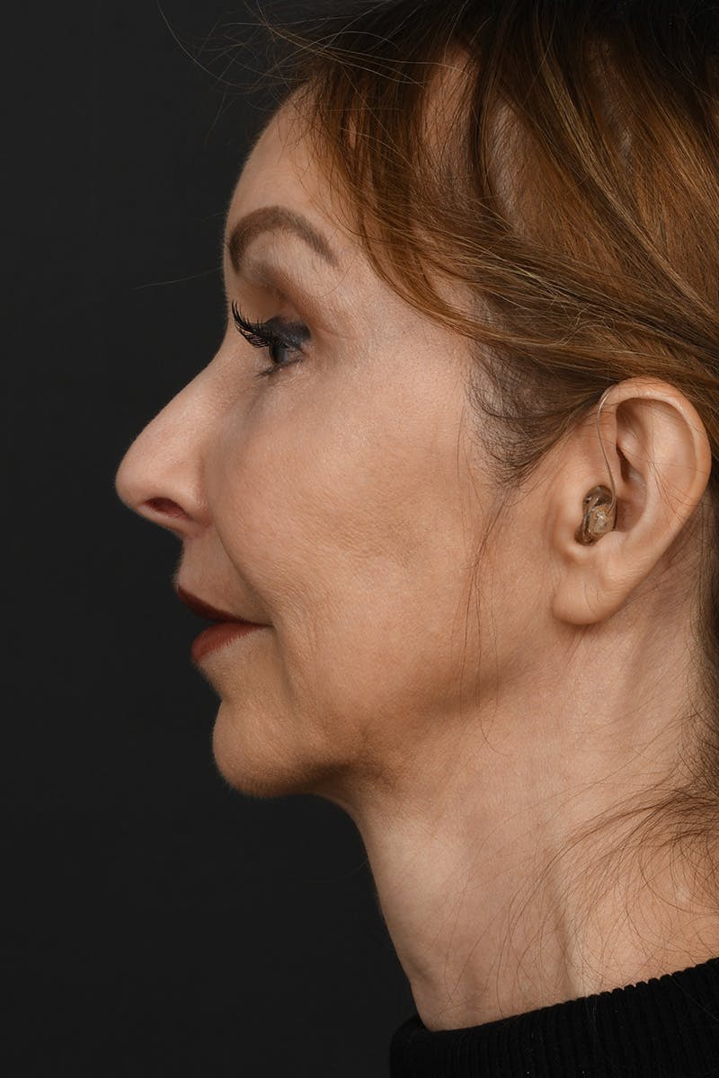 Lip Lift Before & After Gallery - Patient 155407961 - Image 10