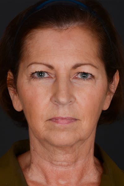 Facelift Before & After Gallery - Patient 155407982 - Image 1
