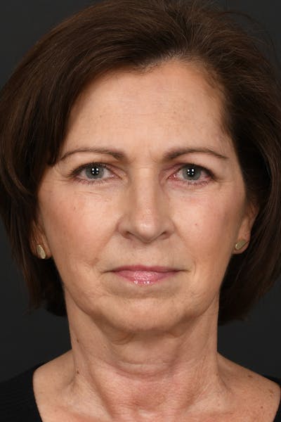 Brow Lift Before & After Gallery - Patient 155407980 - Image 2