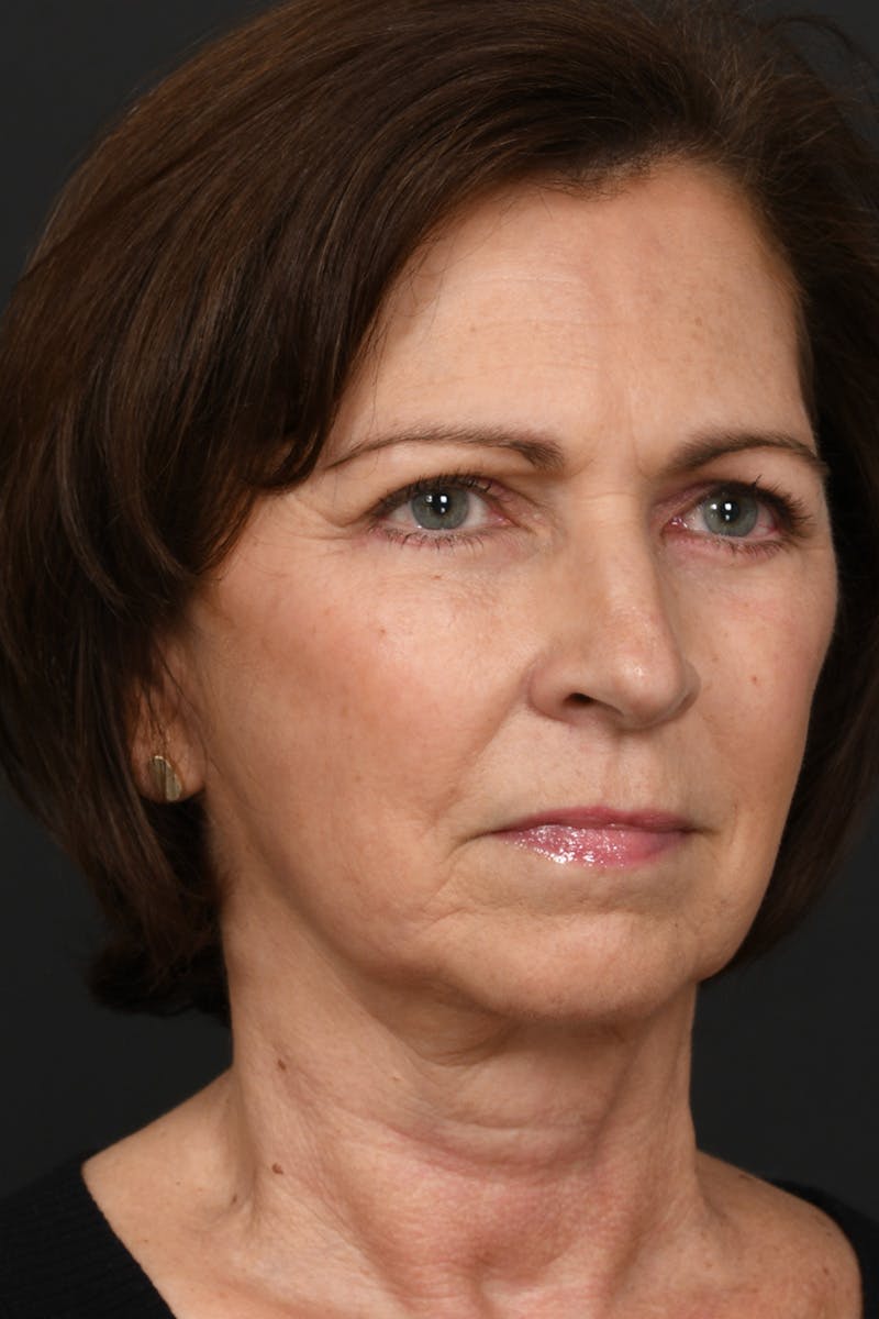 Brow Lift Before & After Gallery - Patient 155407980 - Image 4