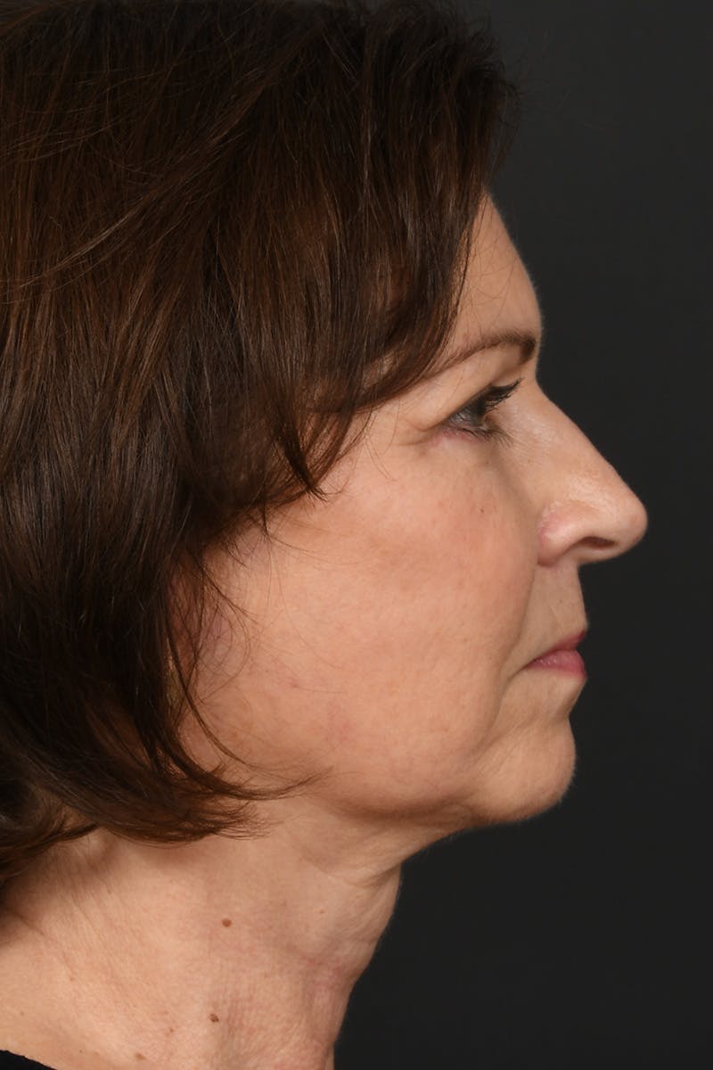 Facelift Before & After Gallery - Patient 155407982 - Image 6