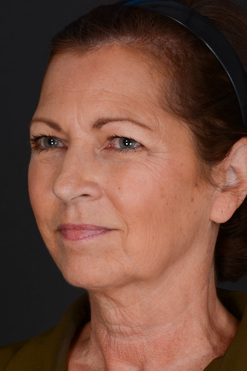 Facelift Before & After Gallery - Patient 155407982 - Image 7