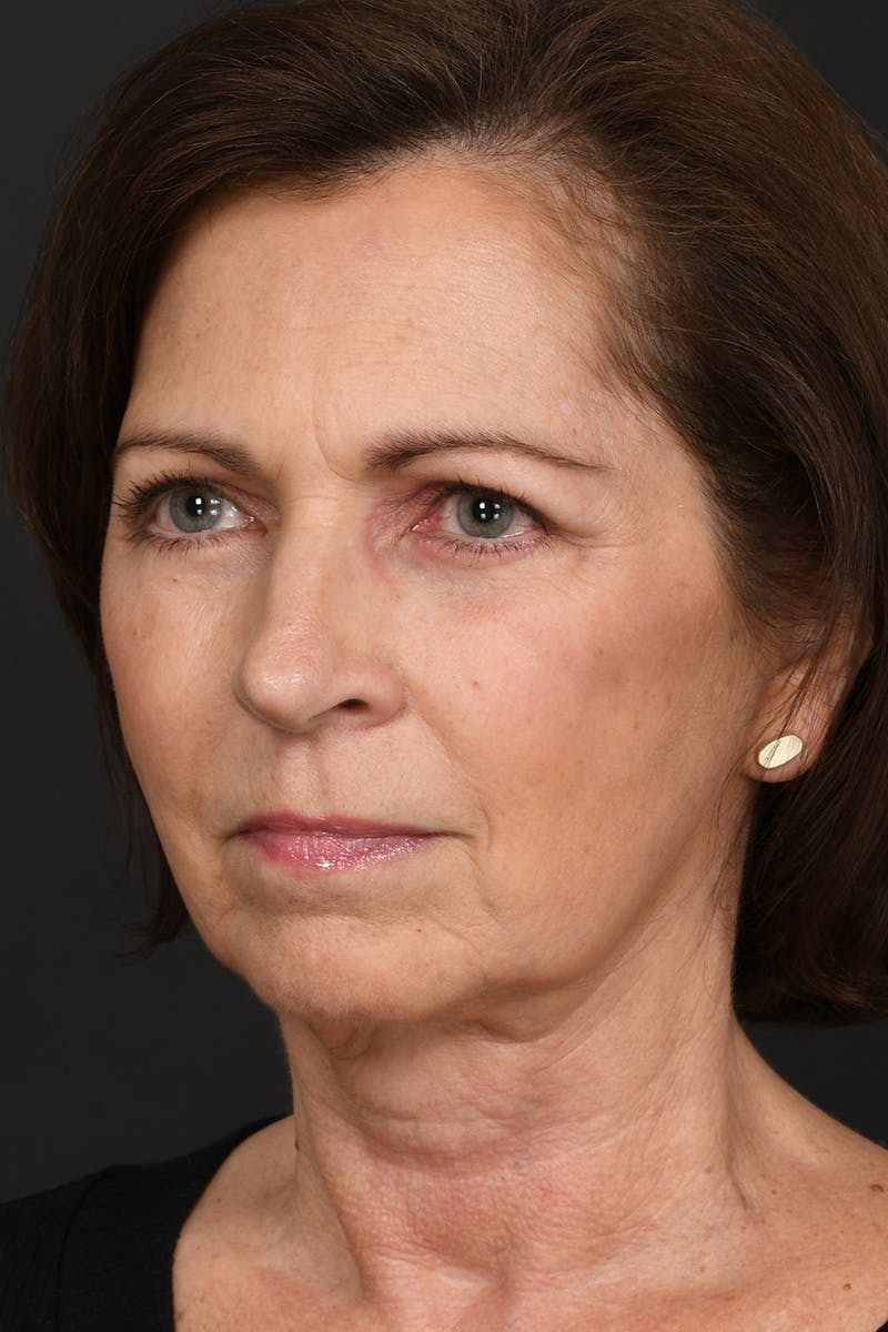 Brow Lift Before & After Gallery - Patient 155407980 - Image 8