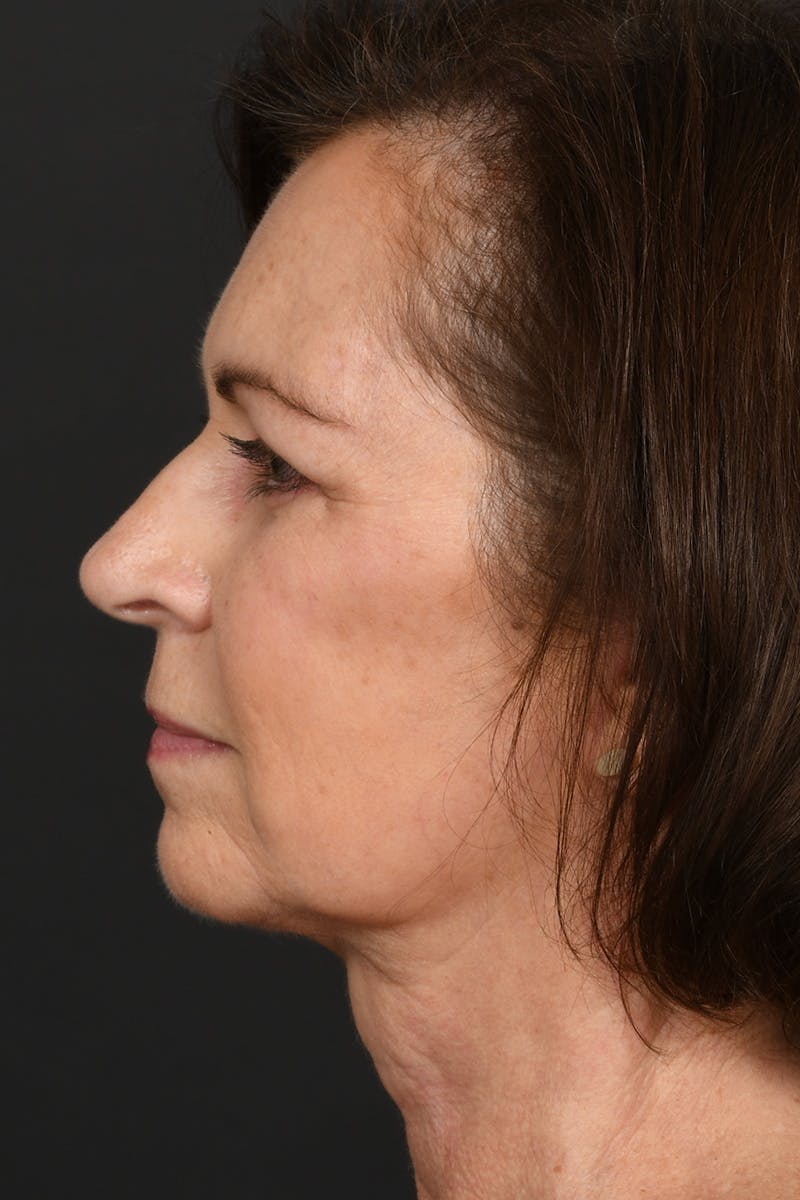 Brow Lift Before & After Gallery - Patient 155407980 - Image 10