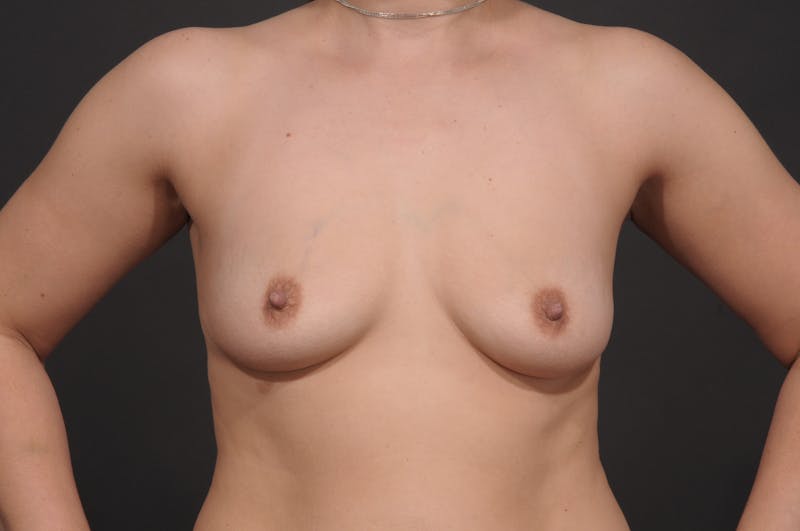 Breast Augmentation Before & After Gallery - Patient 156745723 - Image 3