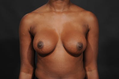 Breast Augmentation Before & After Gallery - Patient 156745721 - Image 2