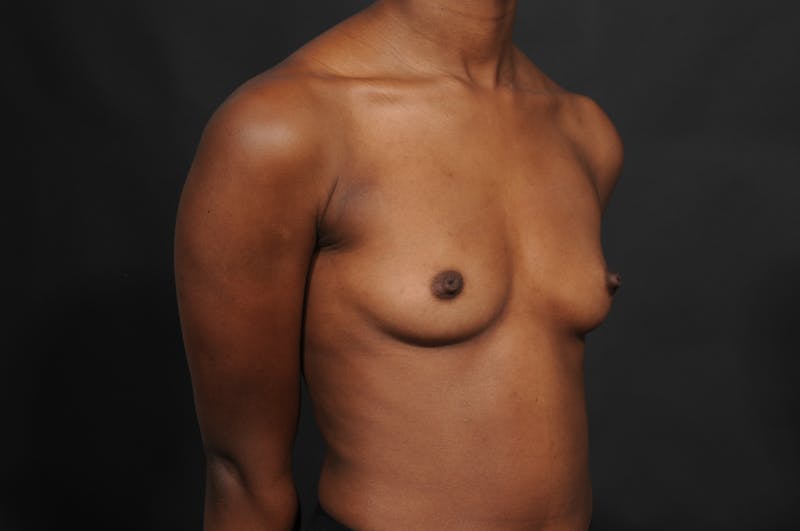Breast Augmentation Before & After Gallery - Patient 156745721 - Image 5
